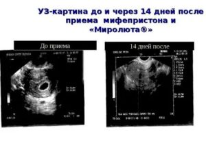 Можно ли сохарнить беременность после приема мифепристона