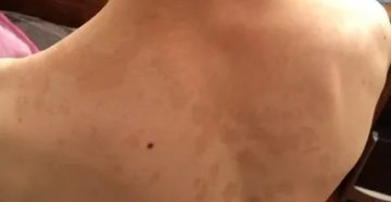 Темные пятна на спине, в чем причина?