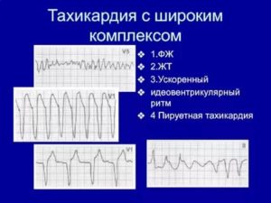 Тахикардия и нарушение адаптации QT