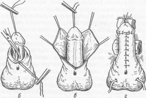 Фимоз и надрыв крайне плоти