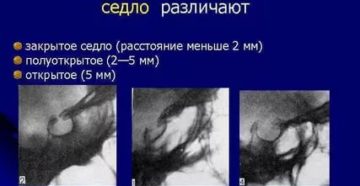 Турецкое седло закрытого типа