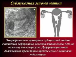 Миома с деформацией полости матки
