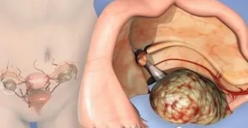 Горят яичники