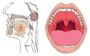 Миндалины повреждение