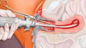 Боли после вакуумной чистке