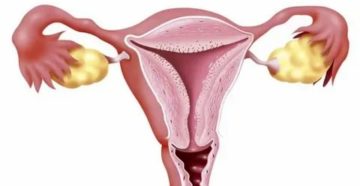 Мягкая матка что это?