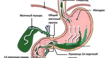 Желчный рефлюкс после гастроэктомии