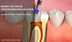 Зуб после перелечивания каналов болит, что делать?