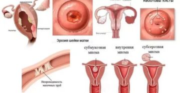 Киста и эрозия Киста и эрозия