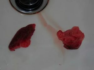 Кровь со сгустками из дёсен