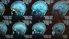 Расшифровка КТ головного мозга ребёнка