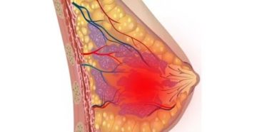 После приема эскапела болит грудь