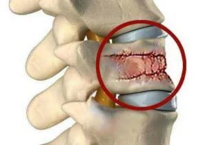 Компрессионный перелом L2 позвонка поясничного отдела позвоночника