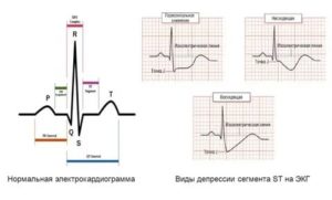Расшифровка кардиограммы, смещение ST вверх (V4)