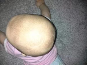 Шишка выпячивает над родничком