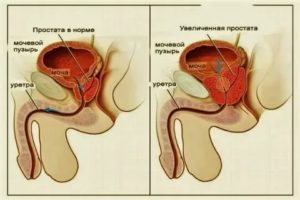 Спазмы в предстательной железе