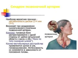 Шум в ухе, головокружение, головная боль, шейный остеохондроз