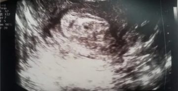 Хгч растет, нет плодного на узи