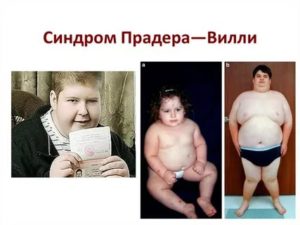 Синдром Прадера-вилли