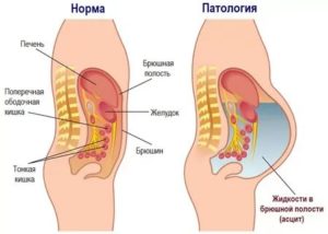 Жидкость в брюшной полости