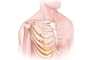 Тяжесть в ребрах после операции на легком
