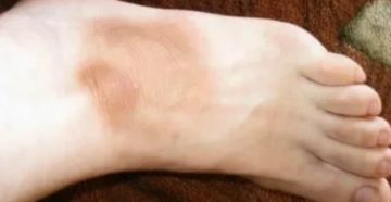 Темное пятно на ступне ноги!