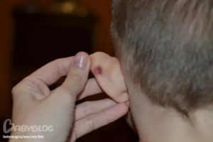 Пятно на ухе у ребёнка