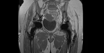 Мрт органов малого таза. Картина неоднократно жидкостного образования (осумкованная жидкость)