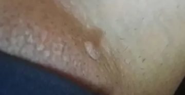 Синий прыщ на половой губе