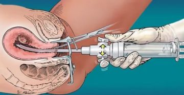 Повторная чистка после вакуумной аспирации Повторная чистка после вакуумной аспирации
