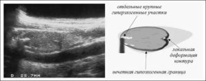 Гипоэхогенный узел с неровным контуром