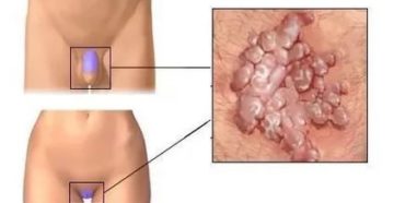 Ушиб малых половых губ