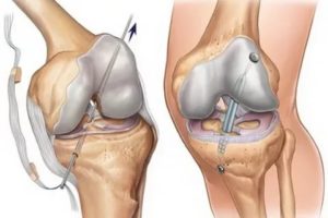 Осложнения после пластики пкс коленного сустава