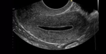 Серозометра при беременности Серозометра при беременности