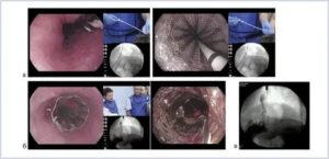 Рак жедудка и последствия стентирования