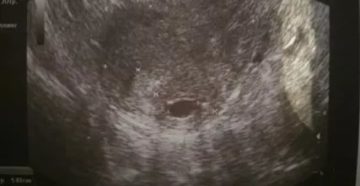 Тонус матки, на узи видно только плодное яйцо Тонус матки, на узи видно только плодное яйцо