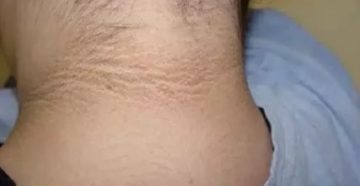 Темные полоски на коже