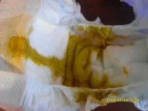 Плохо ест, срыгивания, пукает с калом, постоянно плачет, плохо спит
