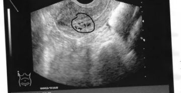 Узи 5 акушерских недель Узи 5 акушерских недель