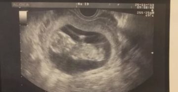 УЗИ 12 недель и 3 дня УЗИ 12 недель и 3 дня