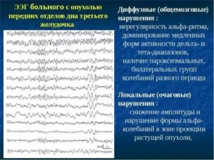 Расшифровка ээг: дизритмические изменения общемозгового характера