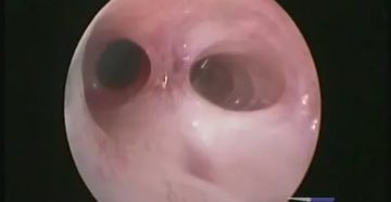 Синехии у девочек Синехии у девочек