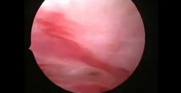 Беременность, кисты в цервикальном канале