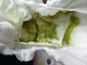Беспокоит серо-зеленый цвет кала у малыша