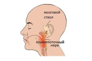 Невралгия языкоглоточного нерва?