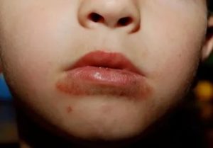 У ребенка 8 лет пятна вокруг губ, похожие на кровоизлияние
