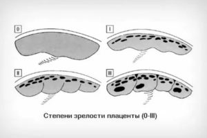 Старение плаценты