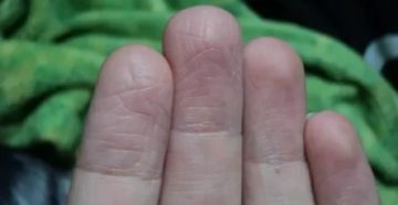 Начали гореть ладони, сморщились подушечки пальцев, проявились пузырьки что это?