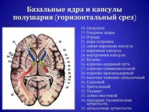 Симметричные мелкие гиперденсивные включения в области базальных ядер