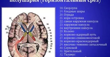 Симметричные мелкие гиперденсивные включения в области базальных ядер